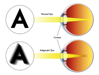 astigmatismo