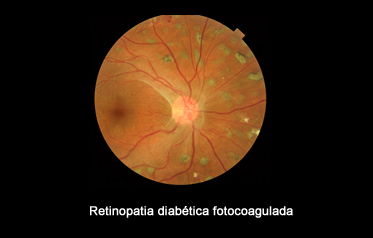 Retinoplastia